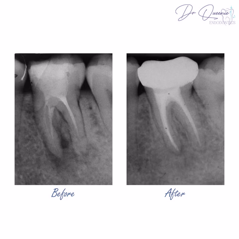 Before and after root canal treatment showing restored tooth health and appearance