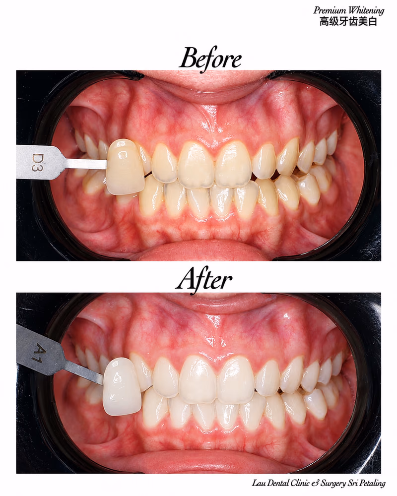 Premium teeth whitening treatment improving tooth shade from D3 to A1 for a dramatically brighter smile.