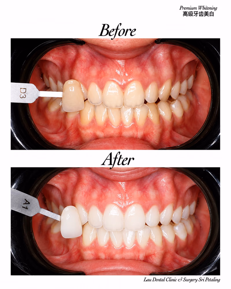 Before and after premium teeth whitening treatment showing noticeable tooth shade improvement and a brighter smile.