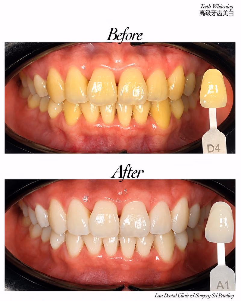 Before and after teeth whitening treatment improving tooth shade from D4 to A1.