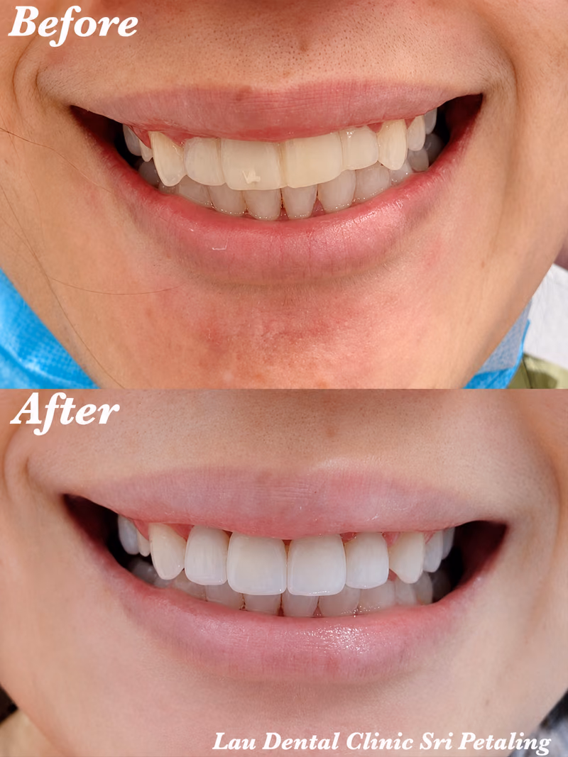Teeth whitening treatment correcting discolored front teeth, restoring a bright and natural-looking smile.