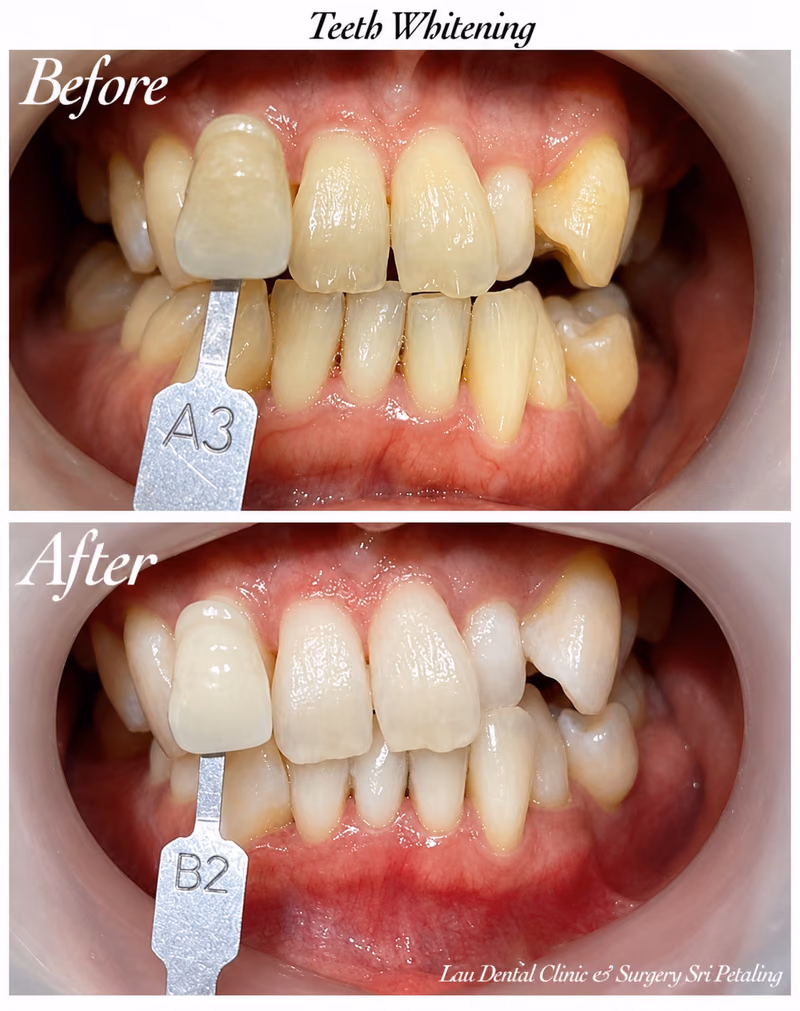 Teeth whitening treatment correcting uneven tooth shade from A3 to B2 for a more uniform, brighter smile.
