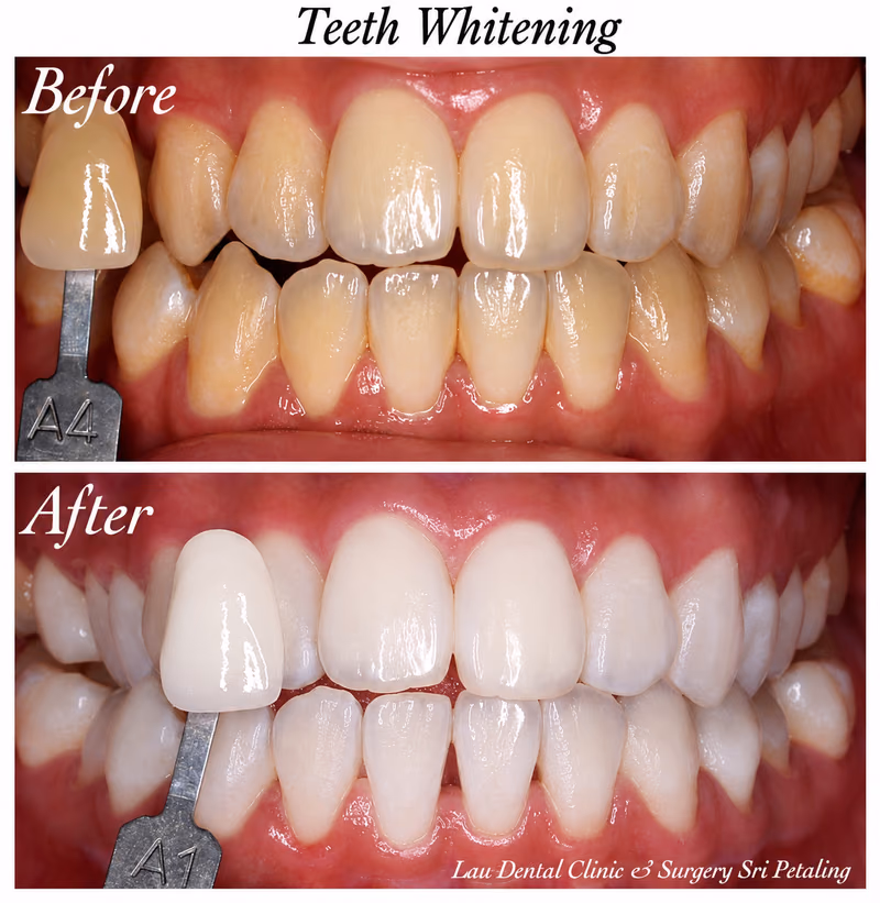 Teeth whitening treatment improving tooth shade from A4 to A1, restoring a brighter, more even smile.