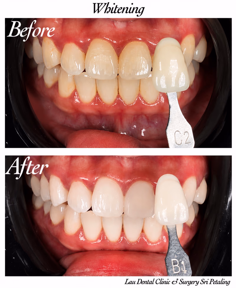 Teeth whitening treatment improving tooth shade from C2 to B1 for an enhanced, more confident smile.