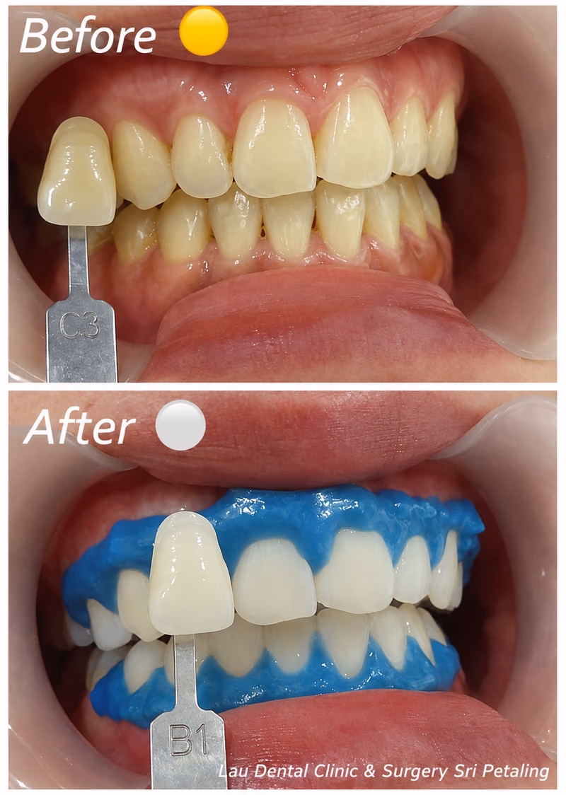 Teeth whitening tray treatment improving tooth shade from C3 to B1 for a brighter, more even and natural smile.
