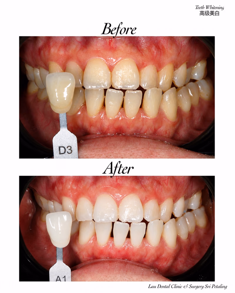 Before and after teeth whitening treatment showing improved tooth shade and a brighter natural smile.