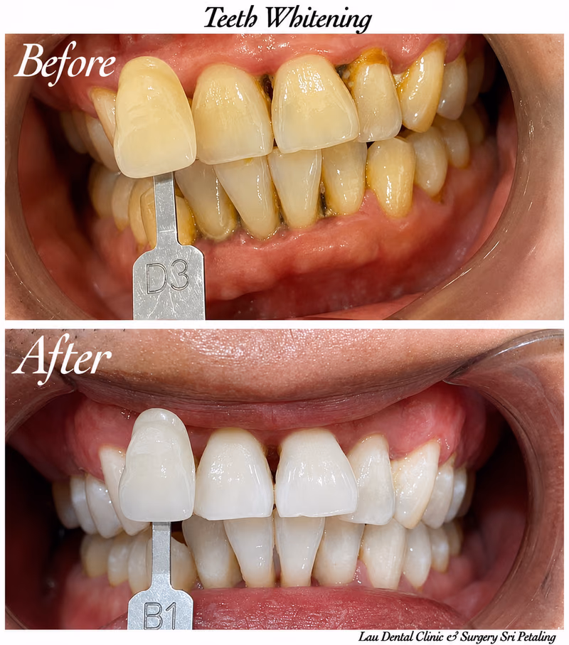 Teeth whitening treatment correcting stained teeth, improving tooth shade from D3 to B1 for a brighter smile.