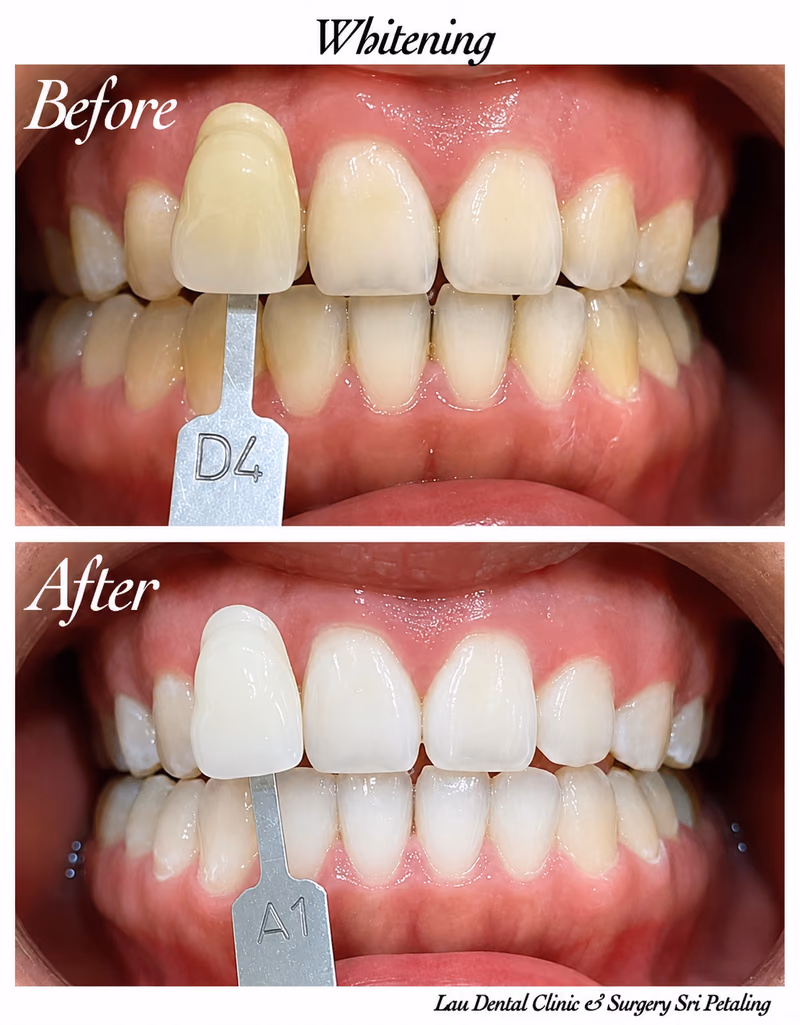 Teeth whitening treatment improving front tooth shade from D4 to A1 for a noticeably brighter smile.