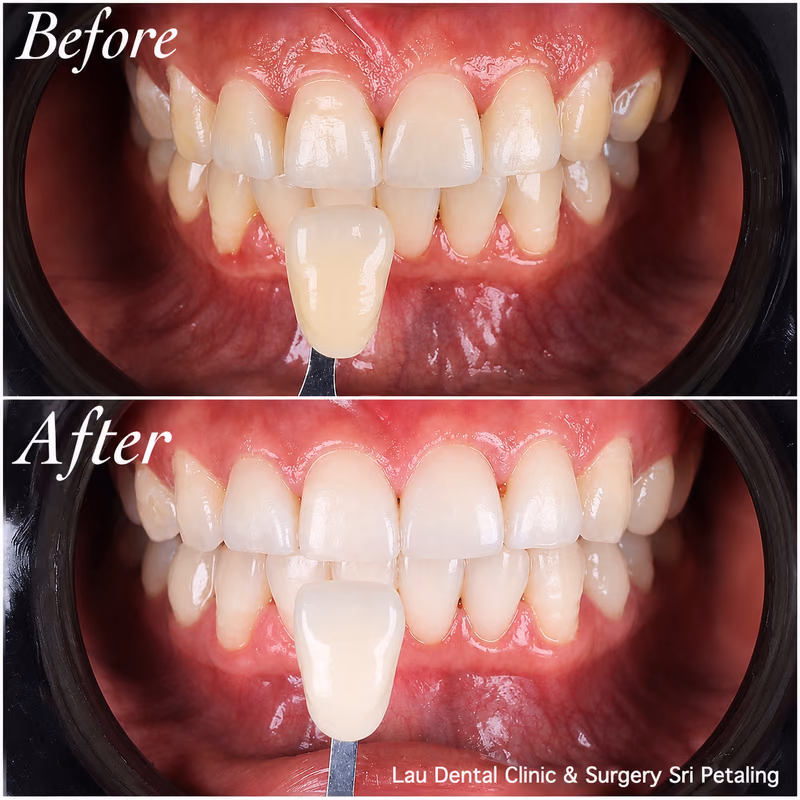 Teeth whitening treatment showing a clear front tooth shade improvement comparison for a brighter, healthier smile.
