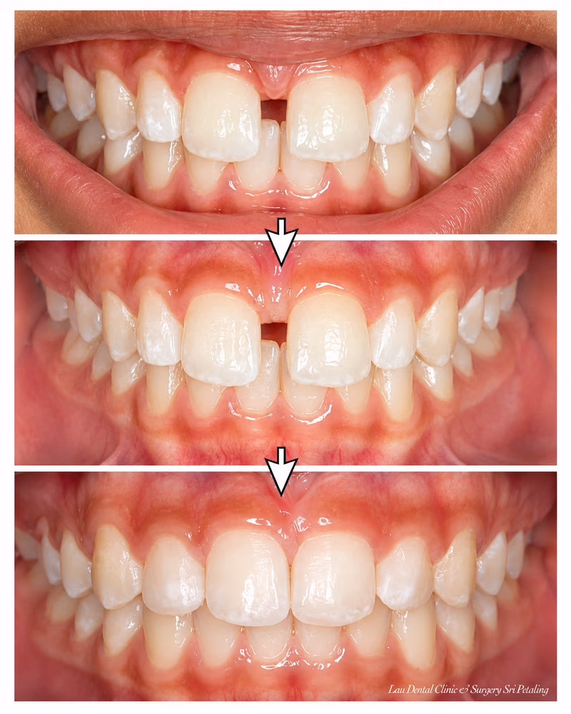 Before and after black triangle closure treatment improving gaps between front teeth.
