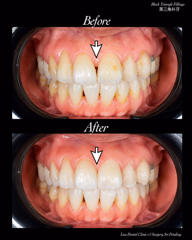 Before and after black triangle filling treatment closing gum gaps between front teeth.