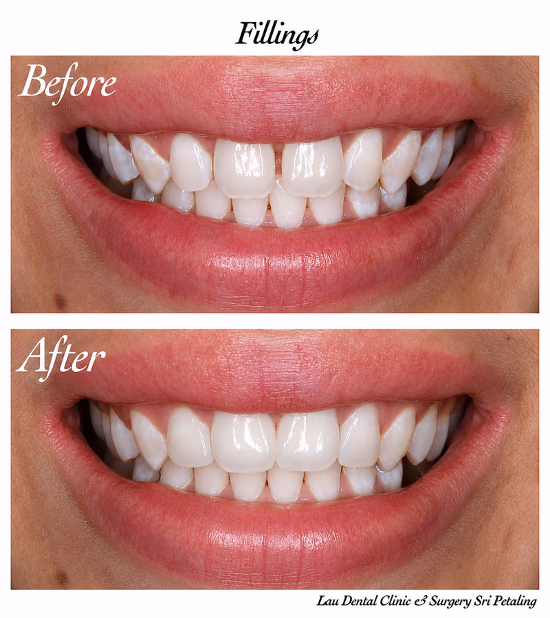 Composite fillings correcting front tooth shade and shape for a more even and natural-looking smile.