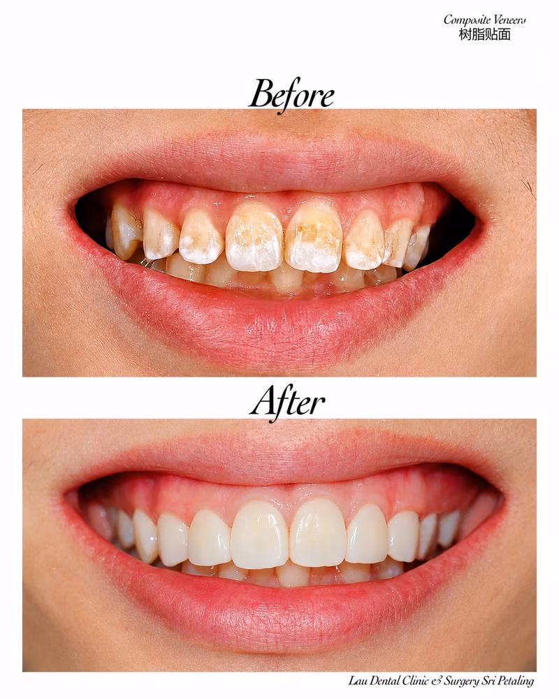 Composite veneers before and after treatment restoring damaged teeth and improving smile aesthetics.