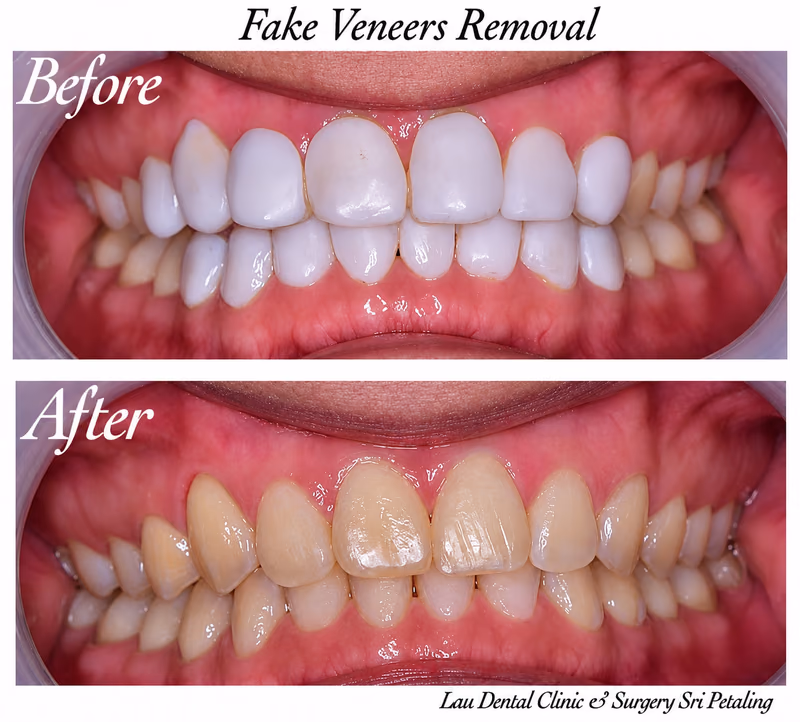 Removal of bulky, ill-fitting fake veneers, restoring the natural tooth structure underneath for better gum health.