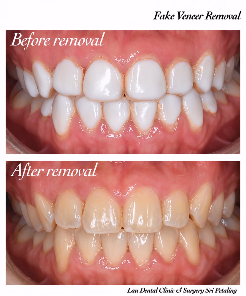 Removal of fake veneers revealing the natural tooth structure, restored back into healthy condition.