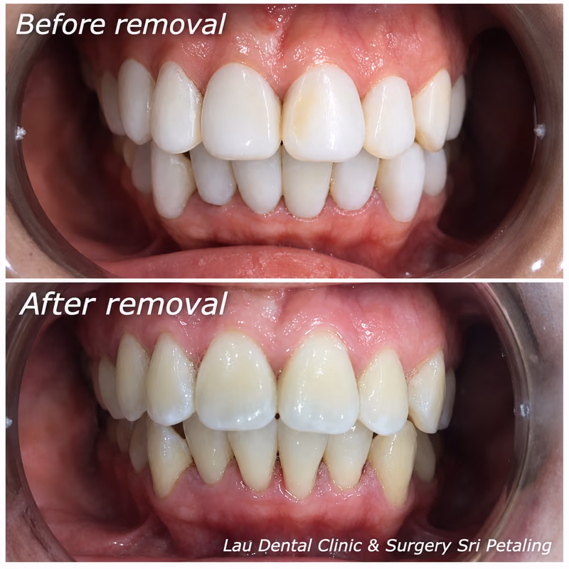 Removal of ill-fitting fake veneers, restoring the natural tooth underneath to a healthier condition.
