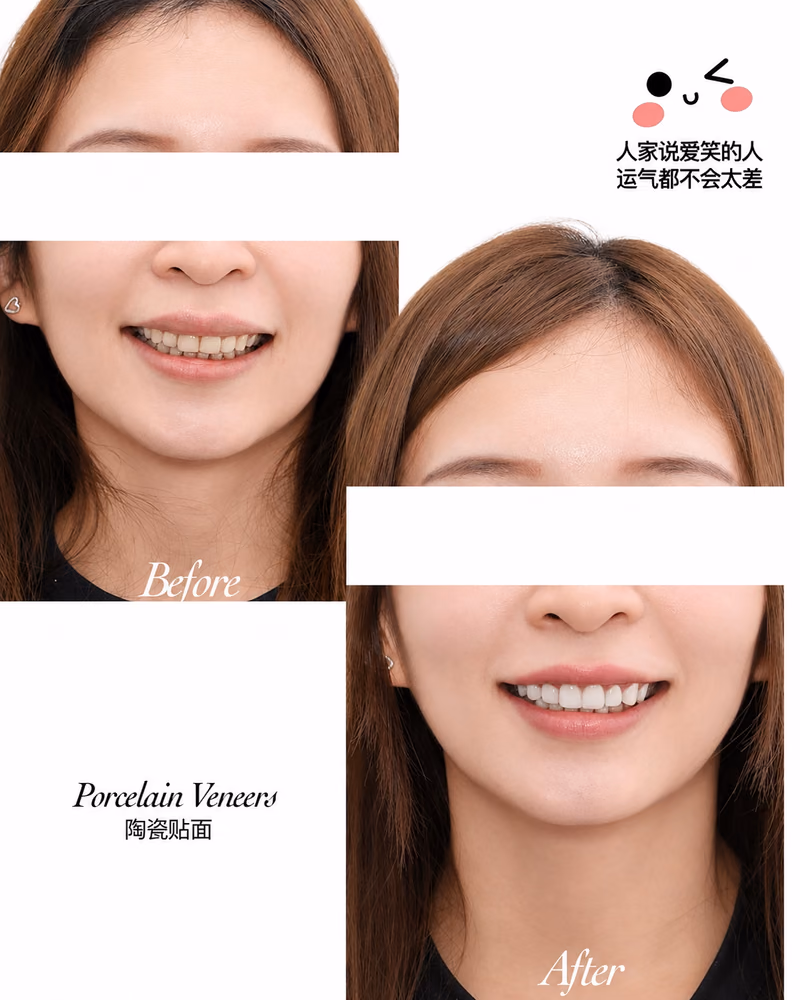 Porcelain veneers before and after smile makeover improving tooth shape, color, and symmetry.