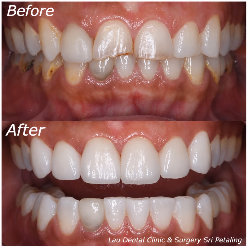Veneers restoring a chipped and discolored front tooth for a natural-looking, even smile appearance.