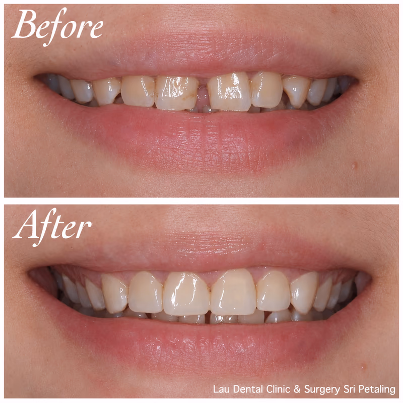 Veneer restoring a chipped front tooth edge, rebuilding natural tooth shape and overall smile confidence.