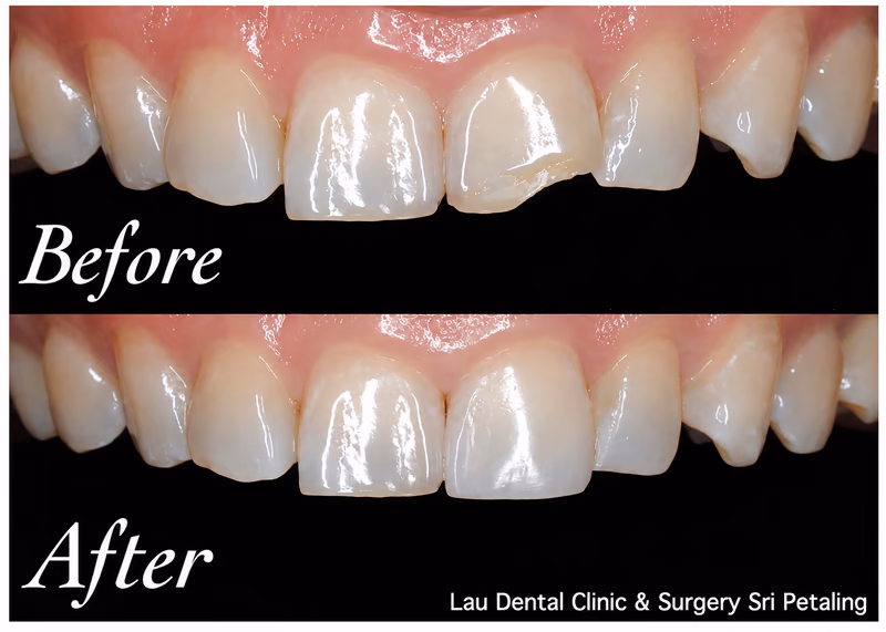 Veneer restoring a chipped front tooth, rebuilding natural tooth shape and stronger tooth structure.