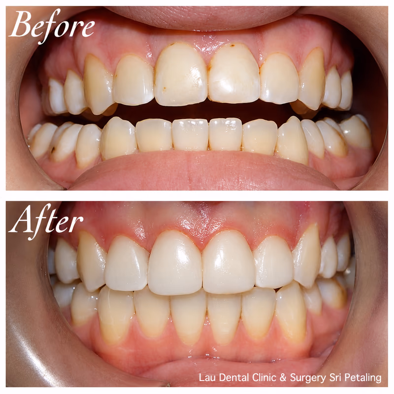 Veneers correcting discolored front teeth, restoring a uniform and natural-looking tooth shade overall.