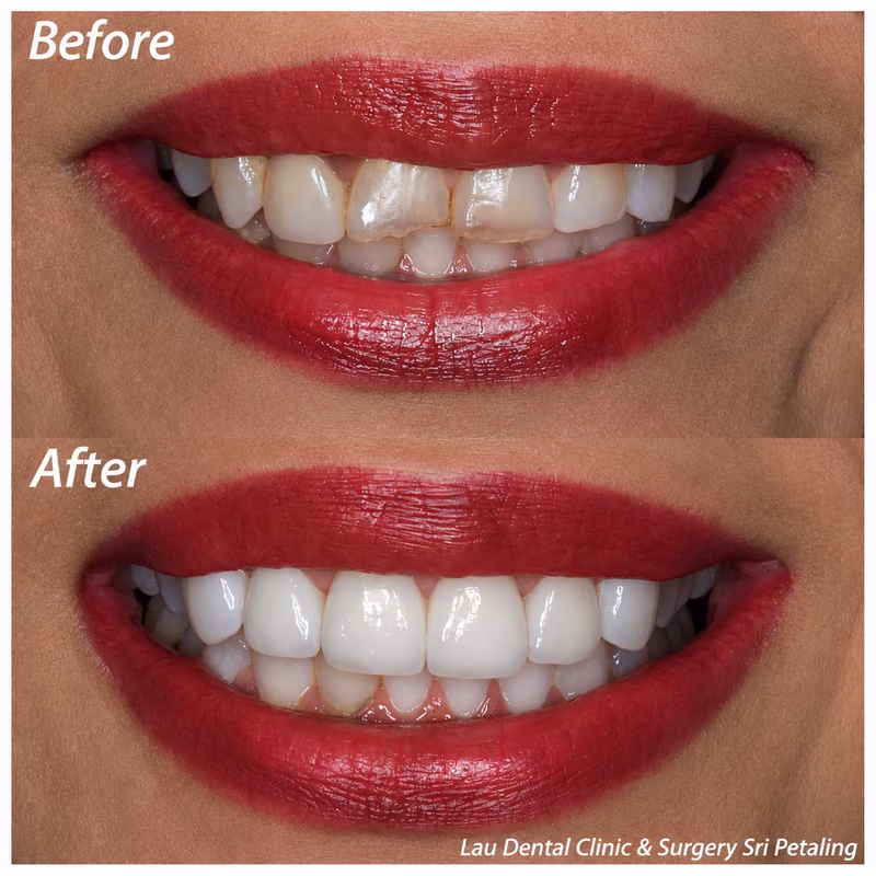 Veneers restoring discolored front teeth into a bright, natural-looking and long-lasting smile result.