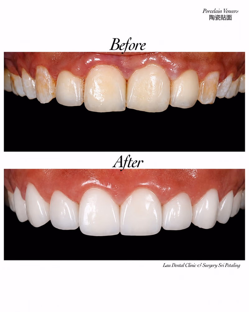Porcelain veneers correcting discolored front teeth, restoring an even and natural-looking tooth shade.