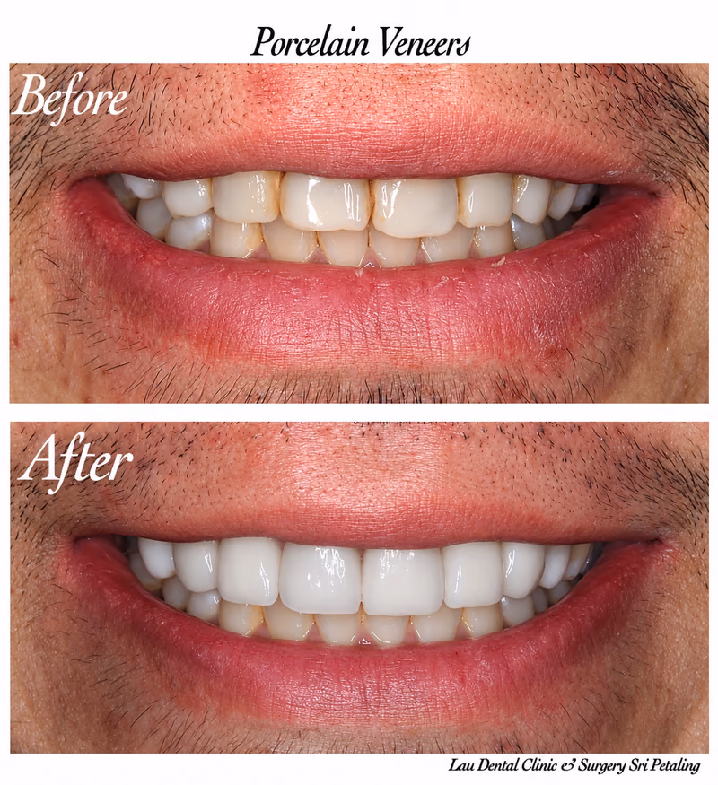 Porcelain veneers restoring discolored front teeth, creating a brighter and more confident male smile.
