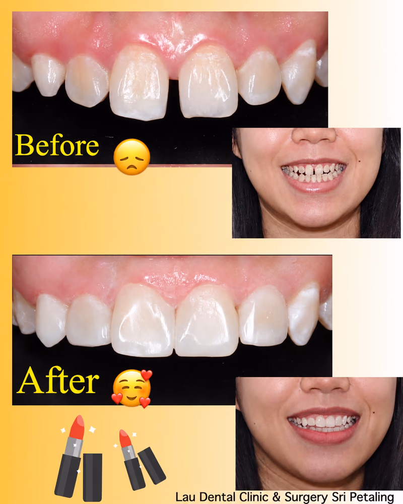 Veneers closing a front tooth gap and correcting crowding for a brighter, more even and balanced smile makeover.