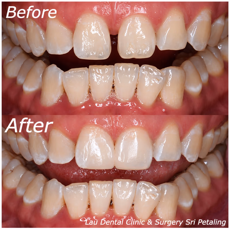 Veneers closing gaps between front teeth, improving alignment for a more confident, even and natural smile.