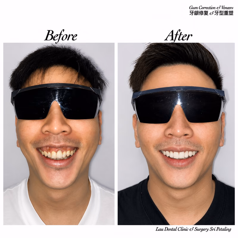 Before and after veneers and gum correction treatment creating a brighter, more symmetrical smile.