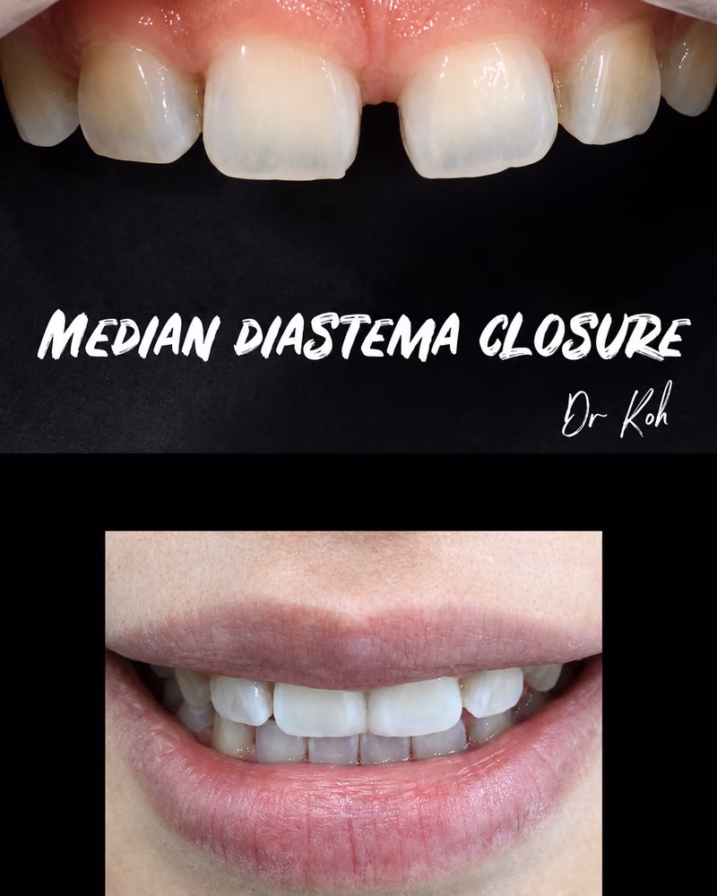 Veneers closing a median diastema gap between the front teeth, restoring a seamless, confident smile.
