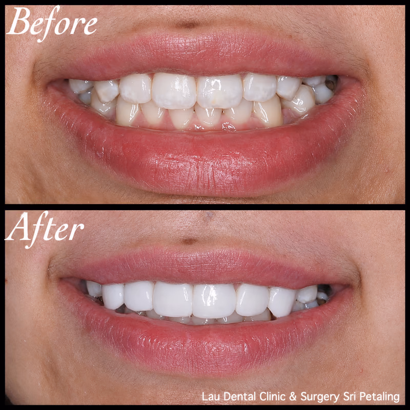 Veneers correcting stained and uneven front teeth, restoring smile confidence and overall tooth symmetry.