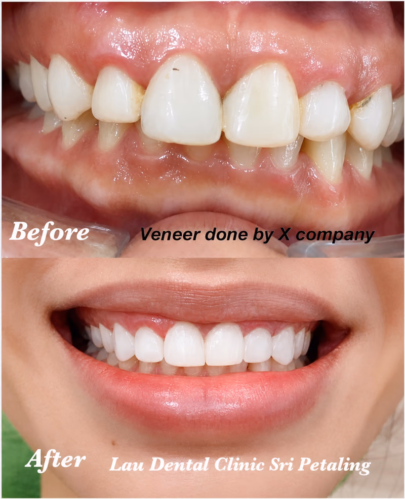 Veneers redo correcting discolored teeth from a previous treatment, restoring a natural-looking smile.