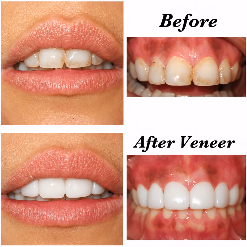Veneers redo correcting a previous third-party restoration, improving front tooth shade and overall shape.