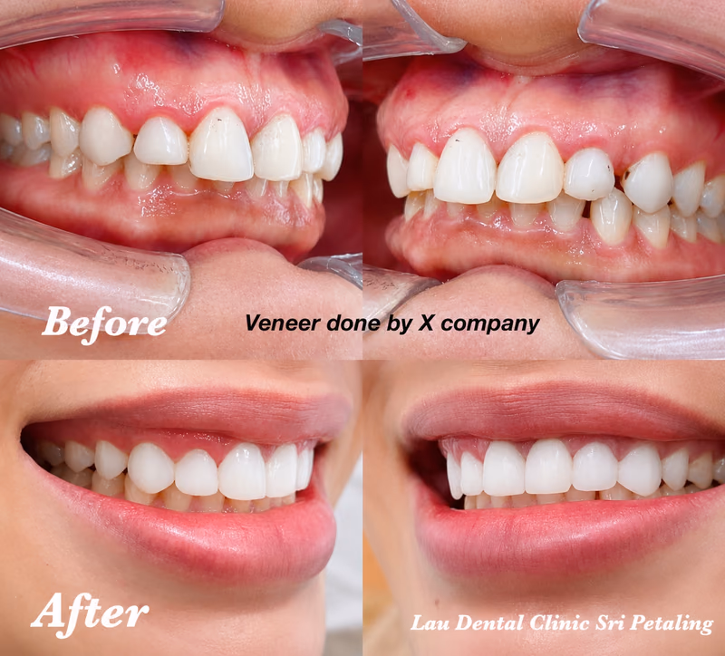 Veneers redo correcting a previous restoration for a more natural-looking, confident and balanced smile result.