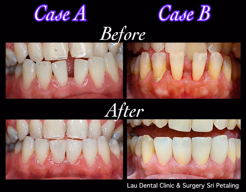 Two veneers cases showing improved gum health and corrected tooth color for a more even, natural-looking smile.