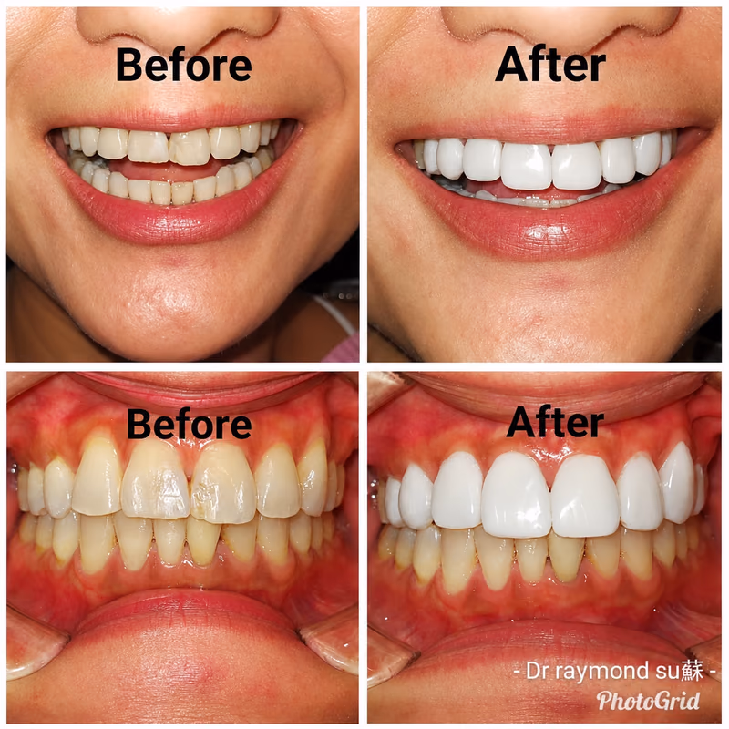 Veneers correcting uneven front teeth, creating a bright and naturally aligned smile makeover result.