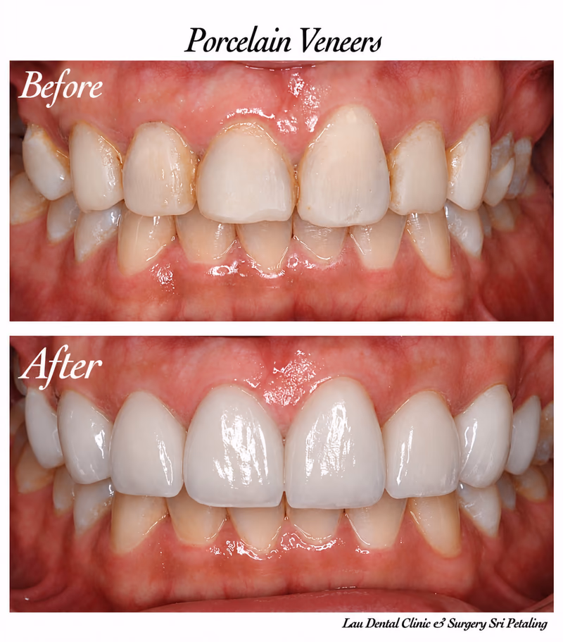 Veneers restoring worn and discolored front teeth for an even tooth shape and improved smile aesthetics.