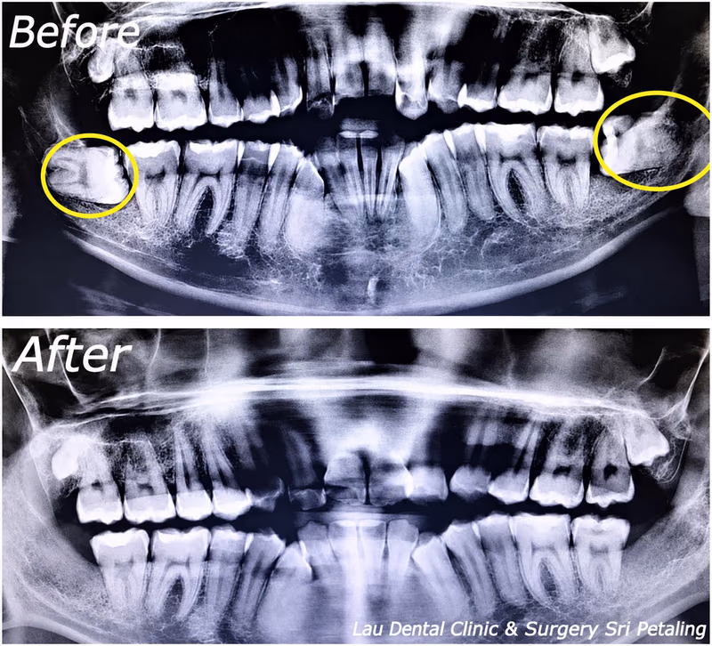 X-ray comparison showing bilateral impacted wisdom teeth before extraction and full healing afterward.
