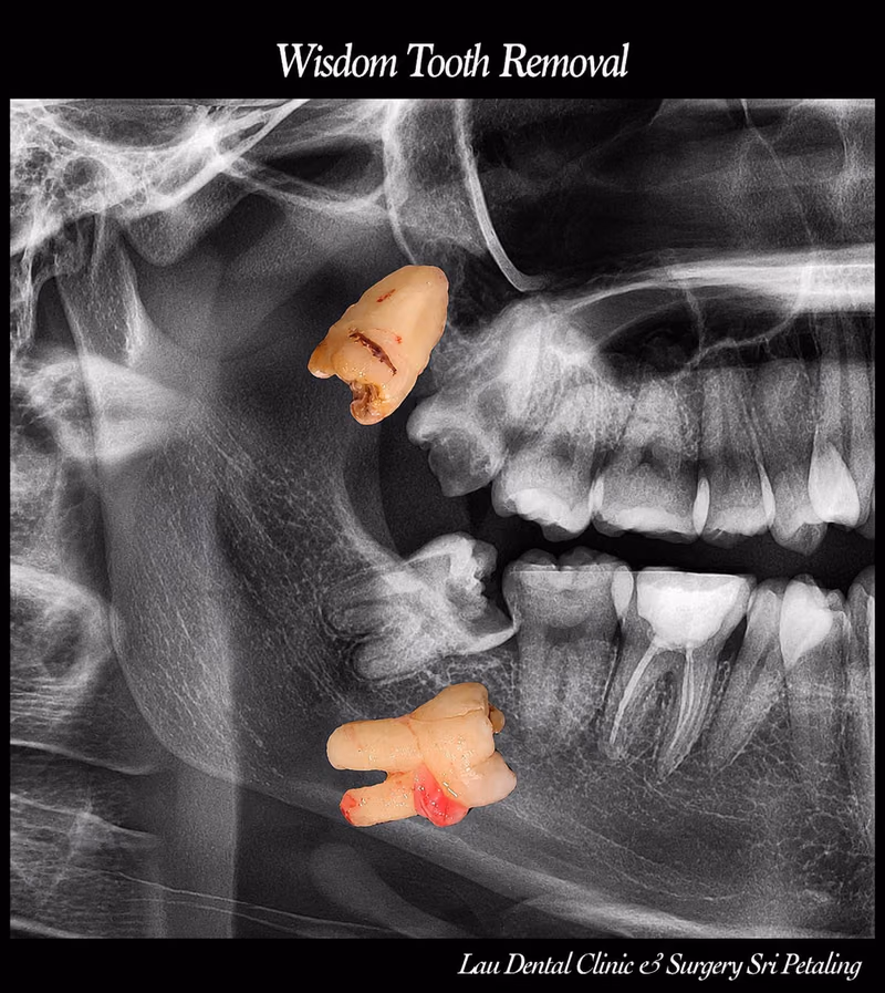 Extracted wisdom teeth shown alongside an x-ray, demonstrating successful impacted tooth removal surgery.