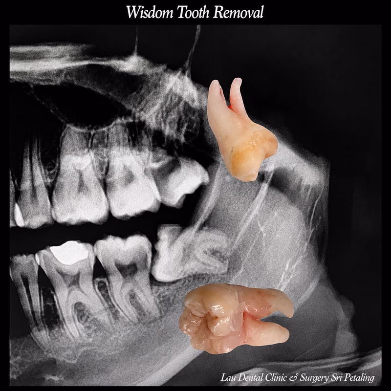 Extracted wisdom teeth specimens shown with an x-ray, confirming complete impacted tooth removal success.