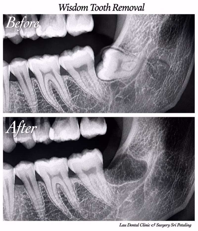 X-ray comparison showing an impacted wisdom tooth before removal and complete bone healing afterward.