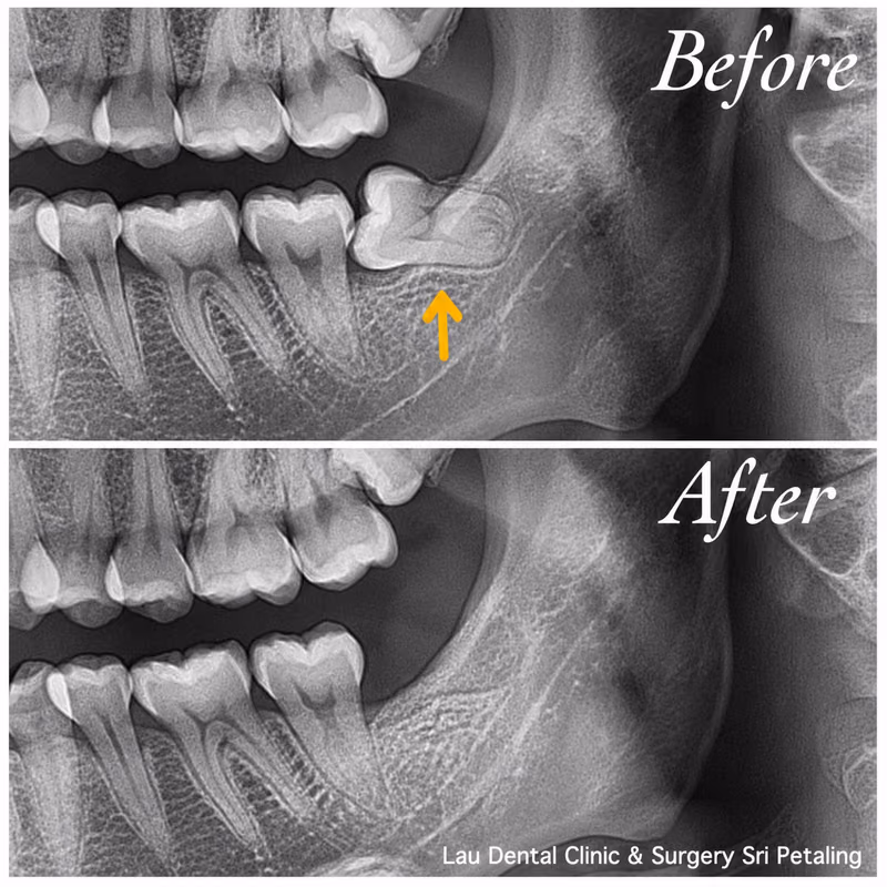 X-ray comparison of an impacted wisdom tooth before extraction and healthy bone healing afterward over time.