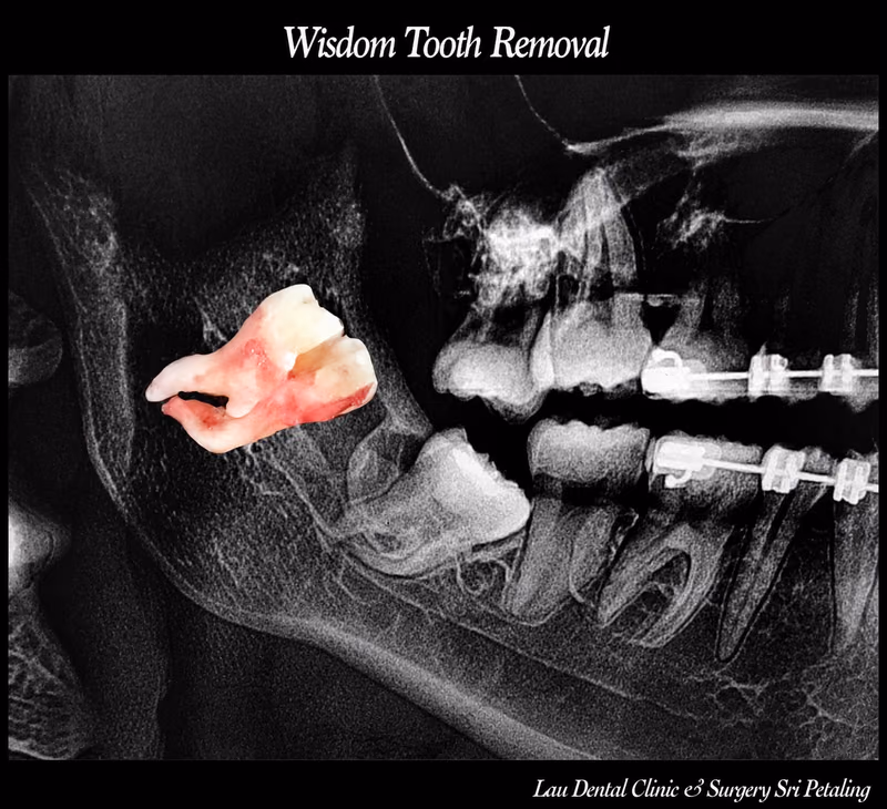 X-ray showing an impacted wisdom tooth near braces, removed to protect ongoing orthodontic treatment.