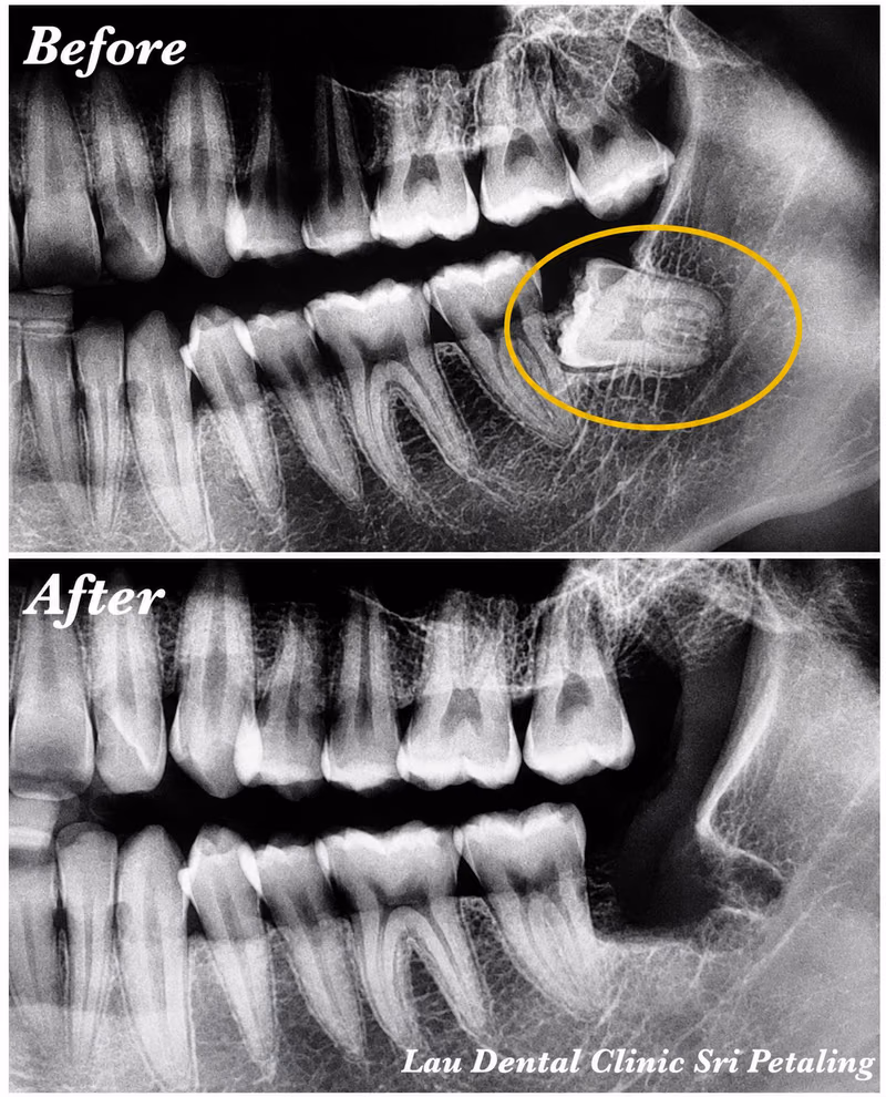 X-ray comparison showing an impacted wisdom tooth in the jaw before extraction and clean healing after.