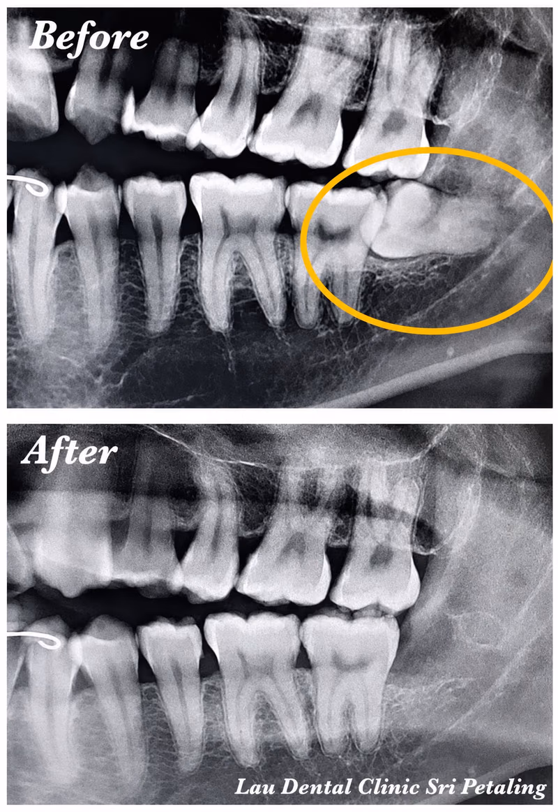 X-ray showing an impacted wisdom tooth before extraction and clean, healthy bone healing afterward over time.