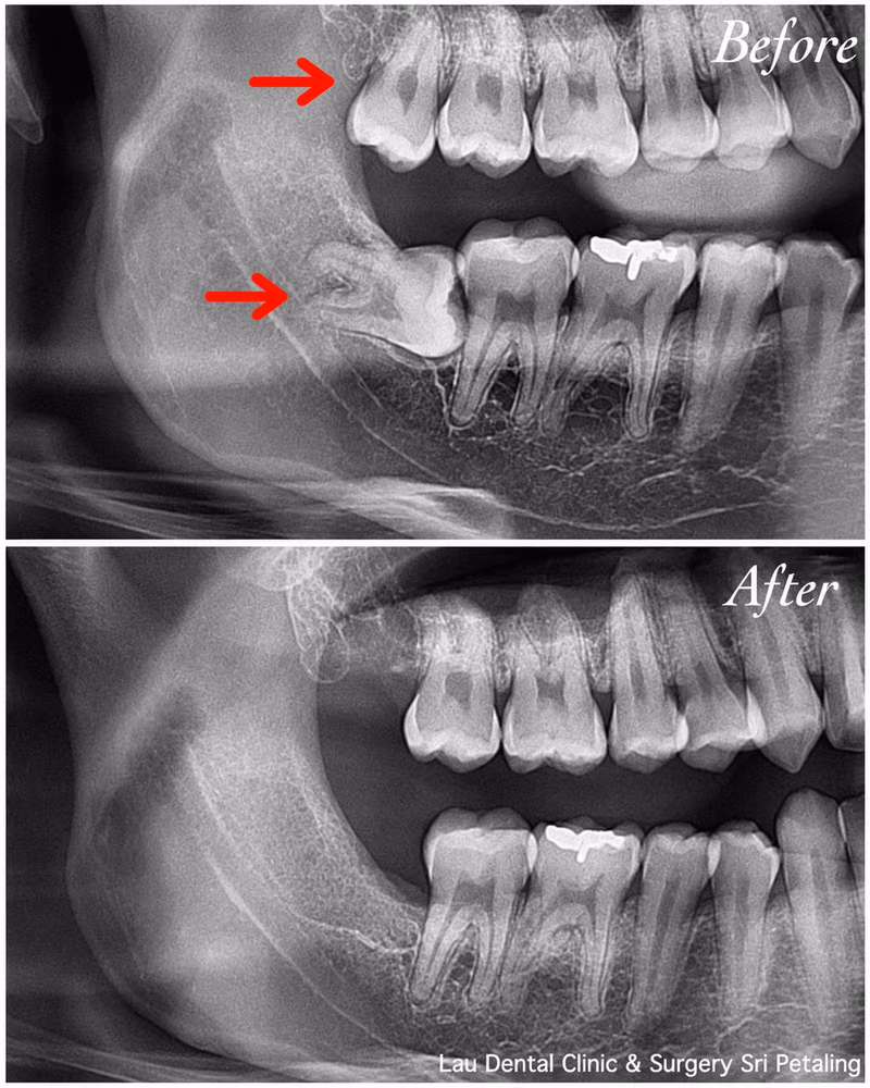 X-ray showing an impacted wisdom tooth causing jaw pressure before extraction and full healing afterward.