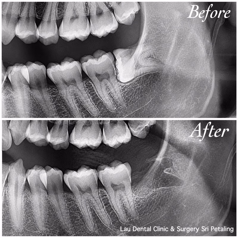 X-ray comparison showing an impacted wisdom molar before extraction and clean bone healing afterward.