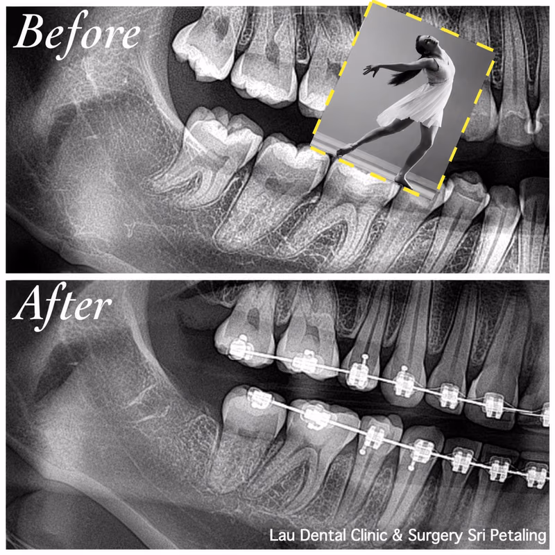 X-ray showing wisdom tooth extraction performed alongside braces treatment for better tooth alignment.